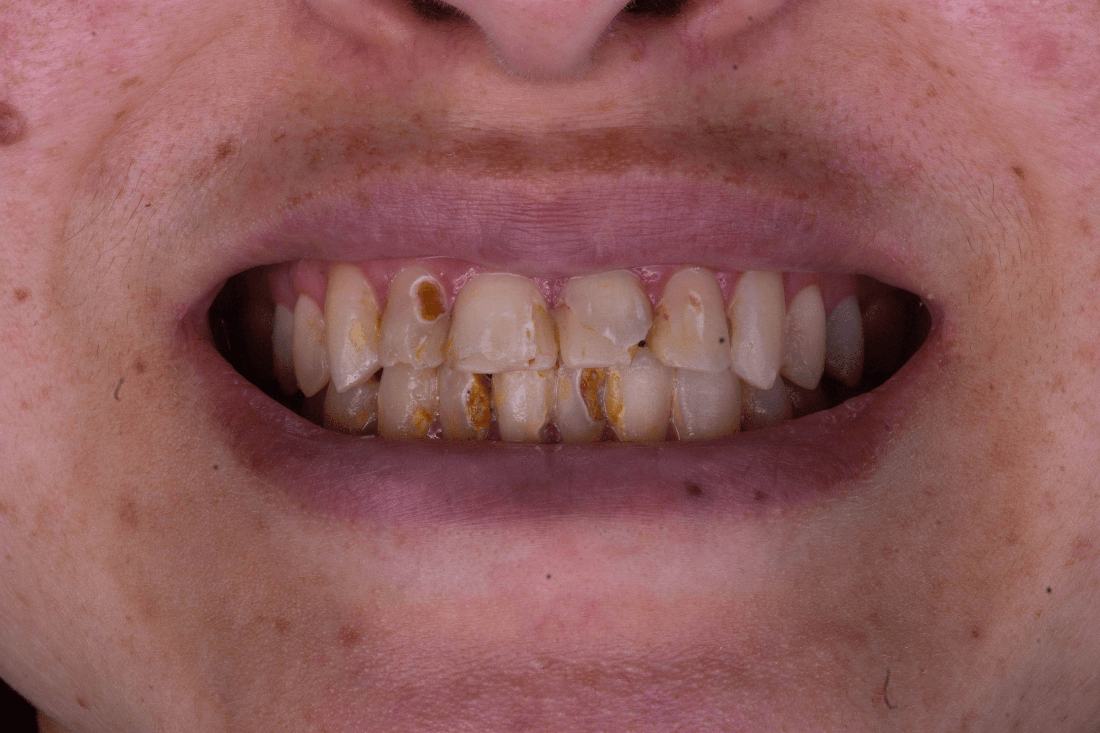 Before the treatment of Porcelain Veneers