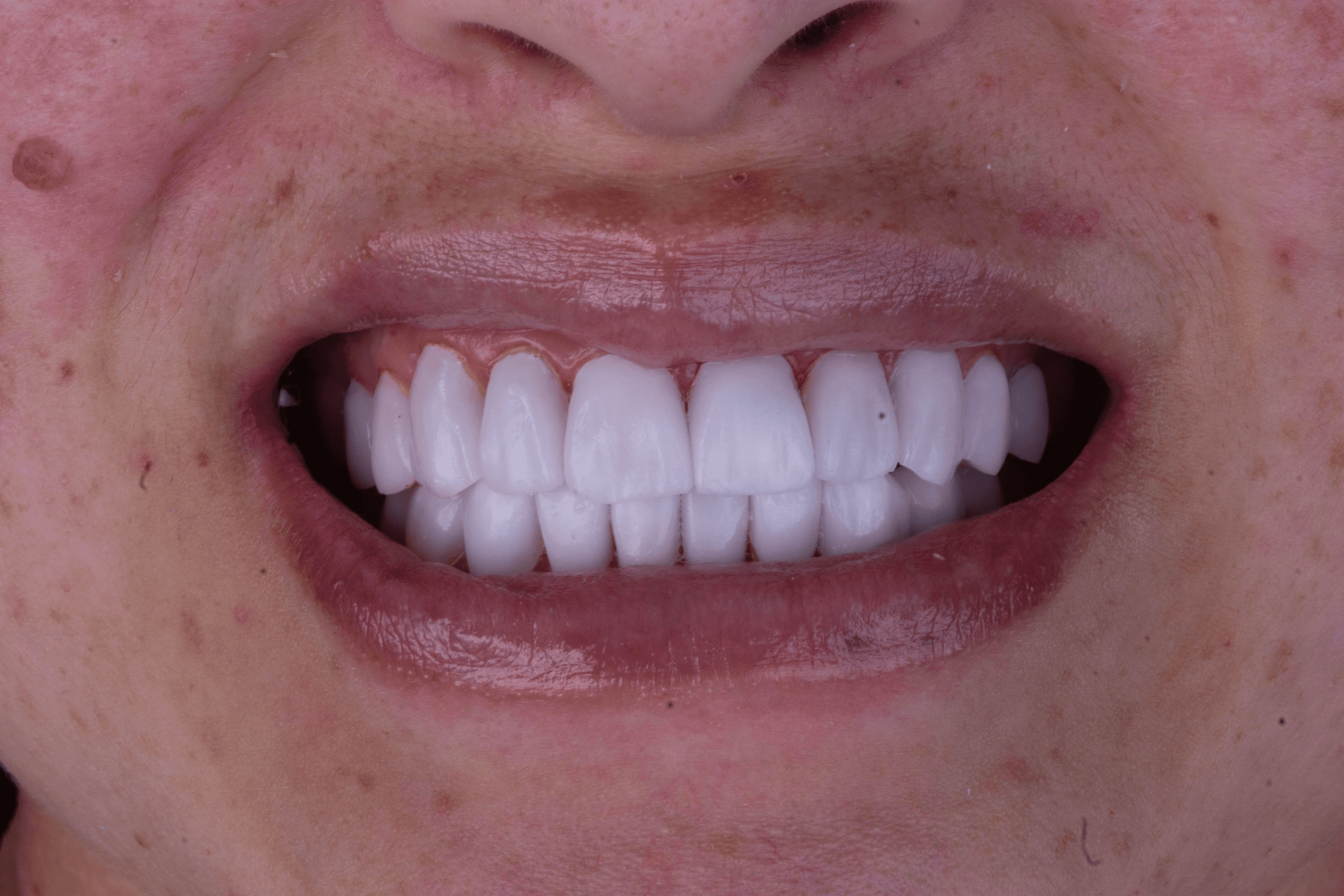 After the treatment of Porcelain Veneers
