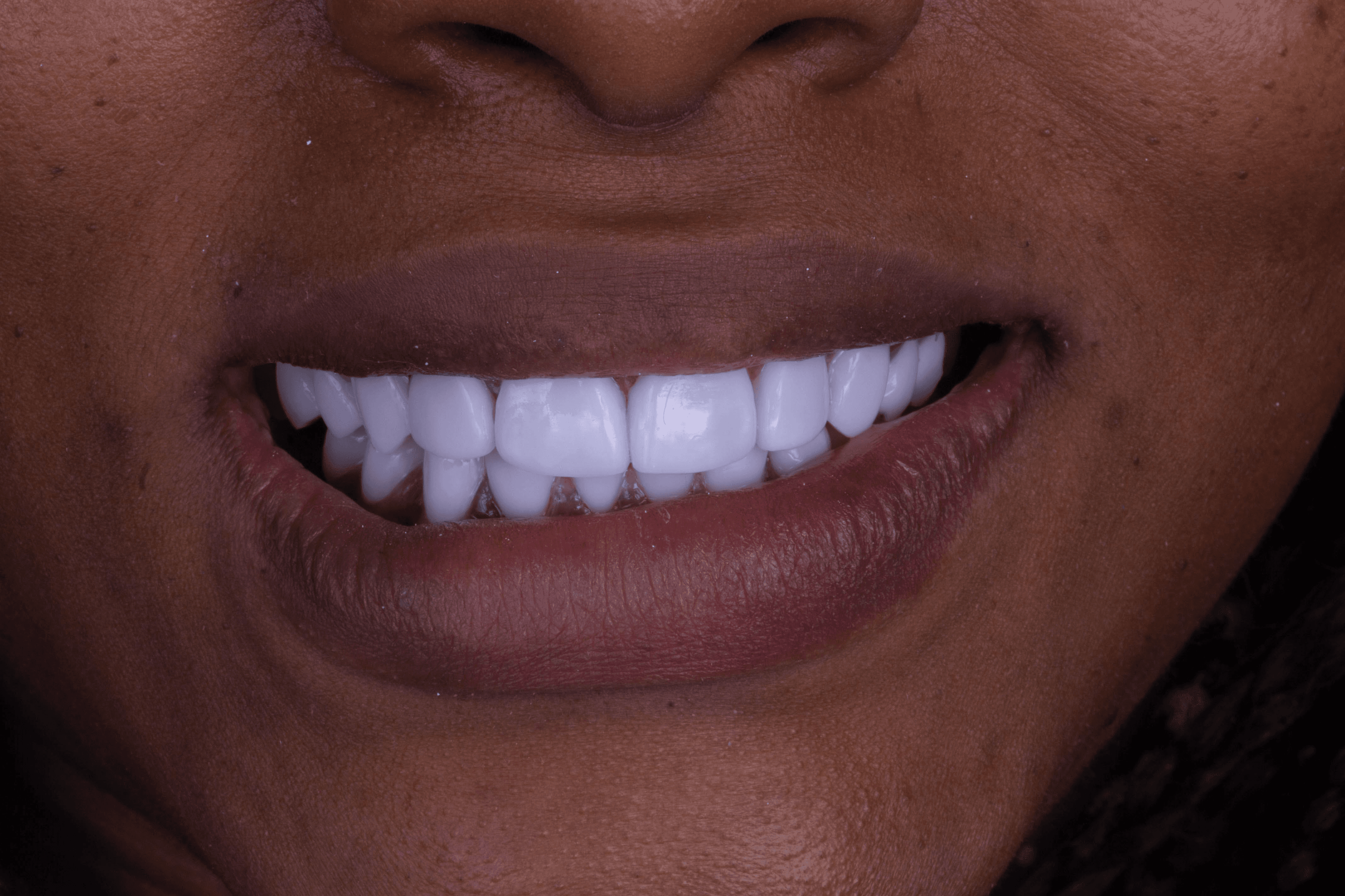 Perfect smile after dental treatment